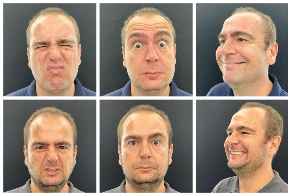 antes e depois da aplicação de botox