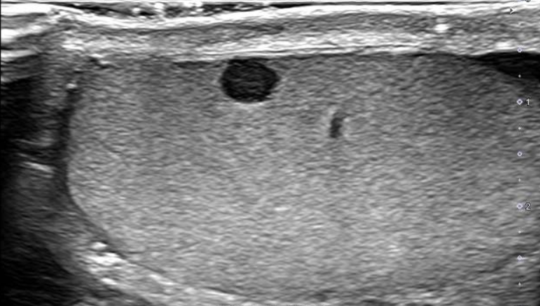 O nódulo de Schrödinger: como é ter e não ter câncer ao mesmo tempo – Parte 1